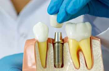 How much are dental implants