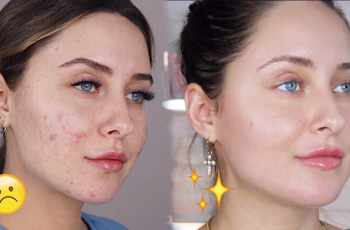 How to get rid of acne scars?