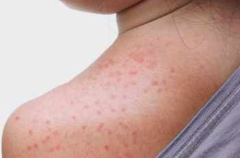 How to treat heat rash?