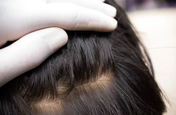 How to remove lice from hair permanently?